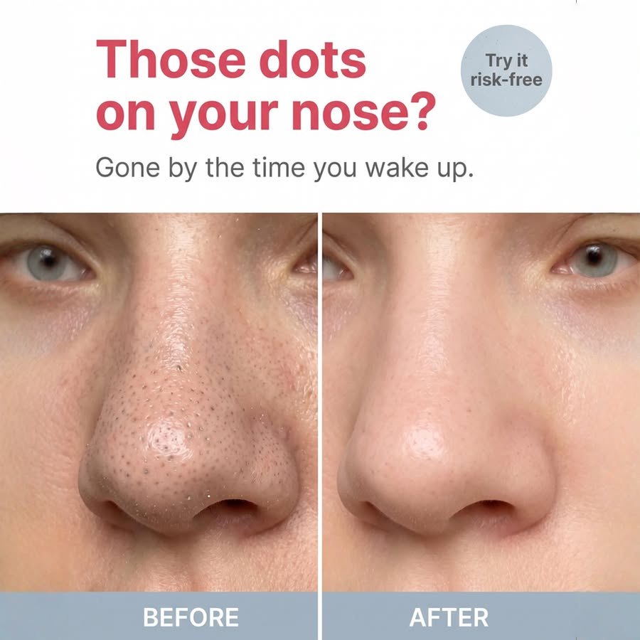 Static for Vue: Those dots on your nose? Gone by the time you wake up. Før og efter.